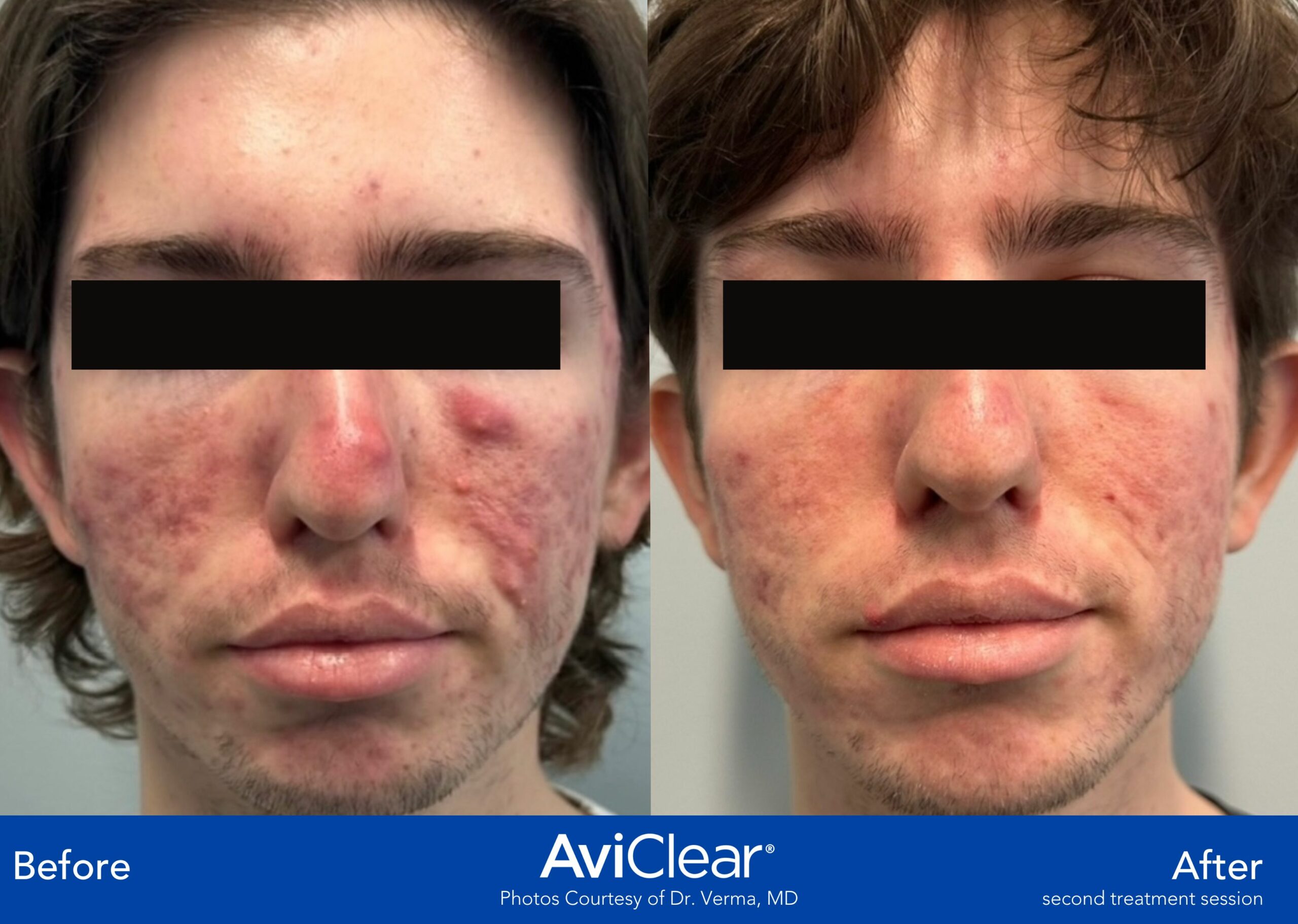 AviClear laser acne treatment before and after