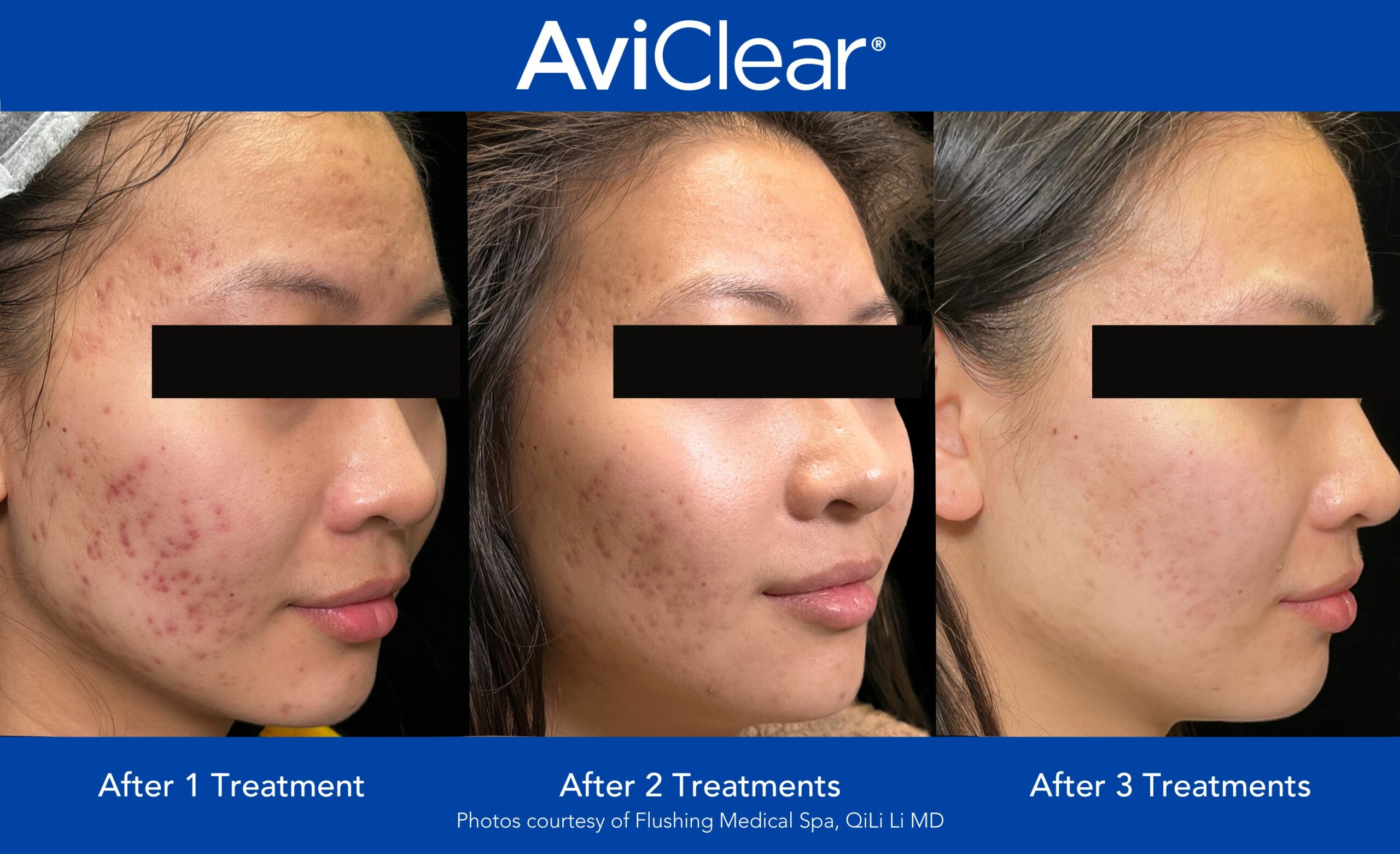 AviClear laser acne treatment before and after