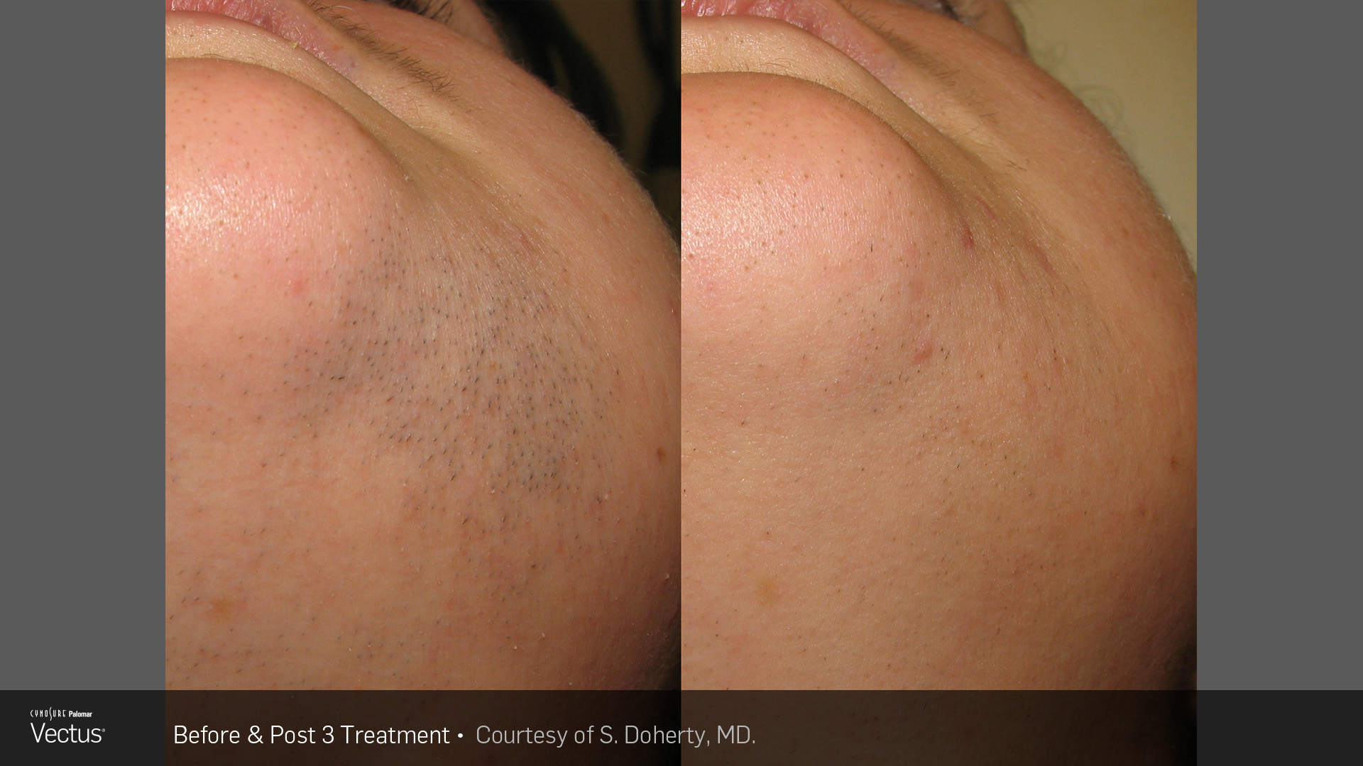 laser hair removal chin hair removal