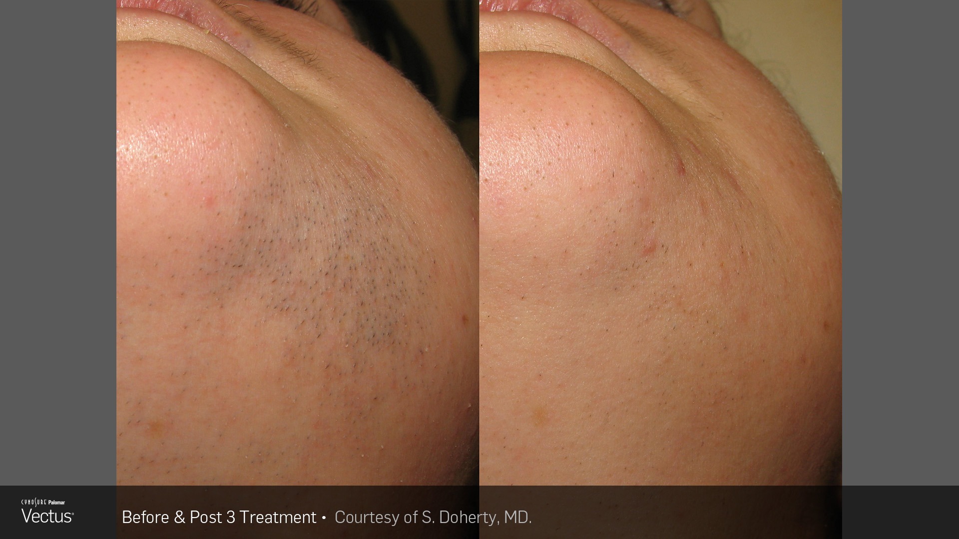 A Beginner s Guide to Laser Hair Removal Healthy Complexions Spa