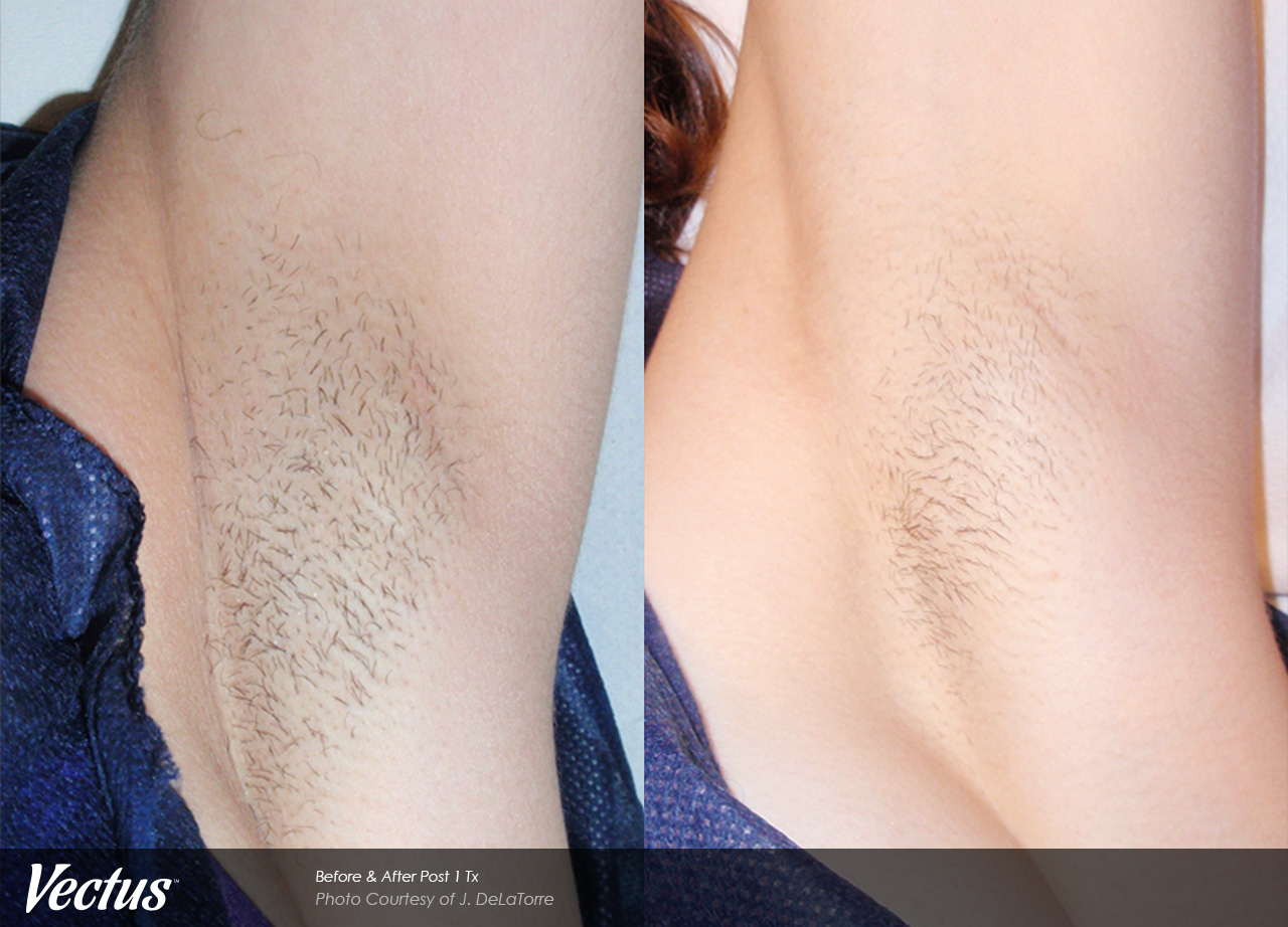 laser hair removal underarm armpit hair removal