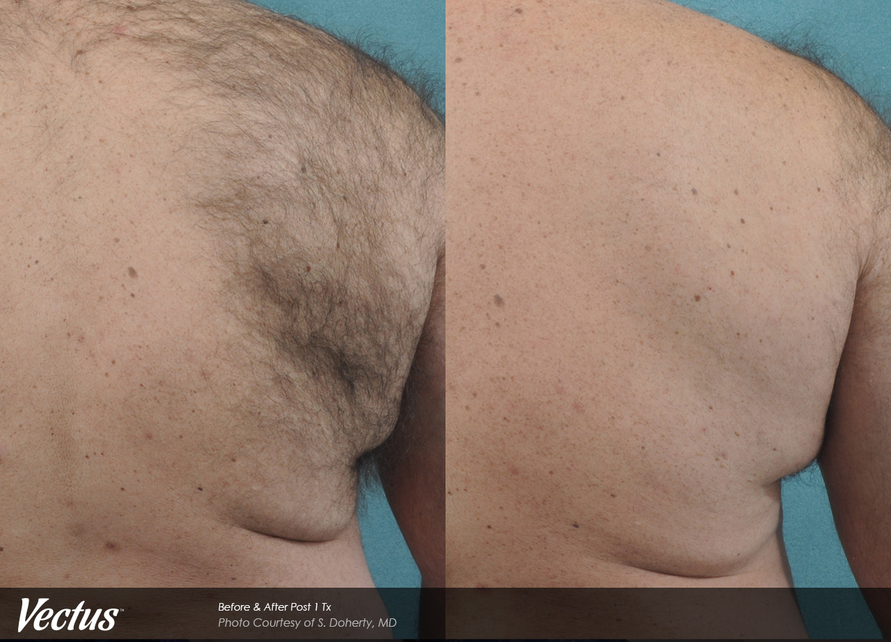 laser hair removal back hair removal