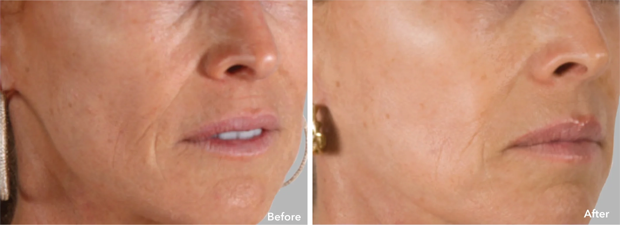 microneedling dermal rolling