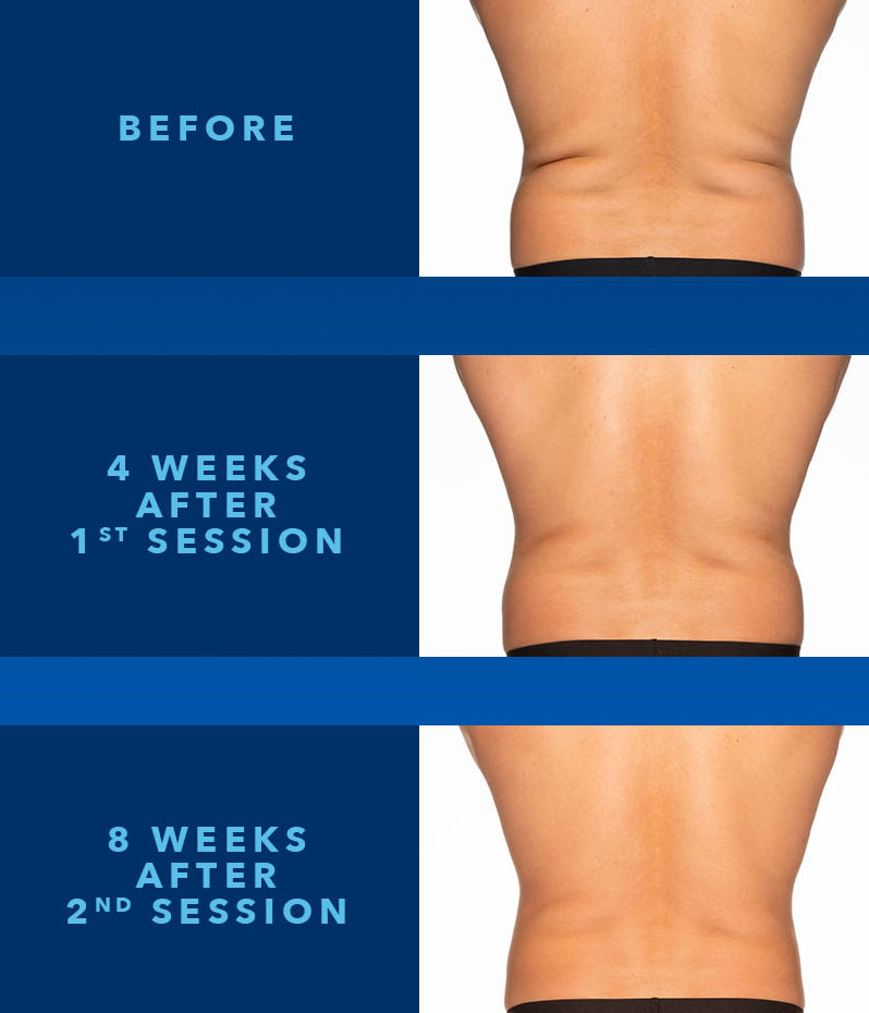 coolsculpting