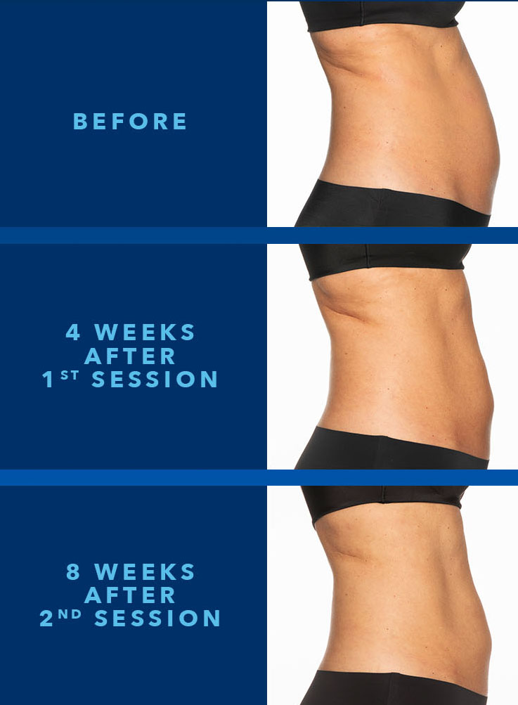 coolsculpting