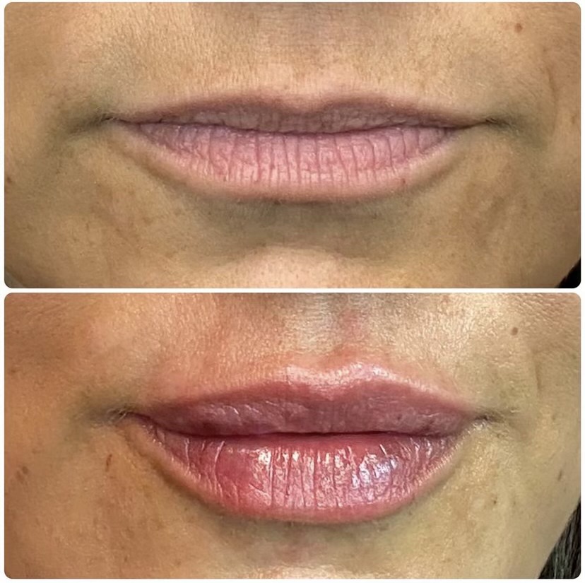 Restylane Kysse before and after