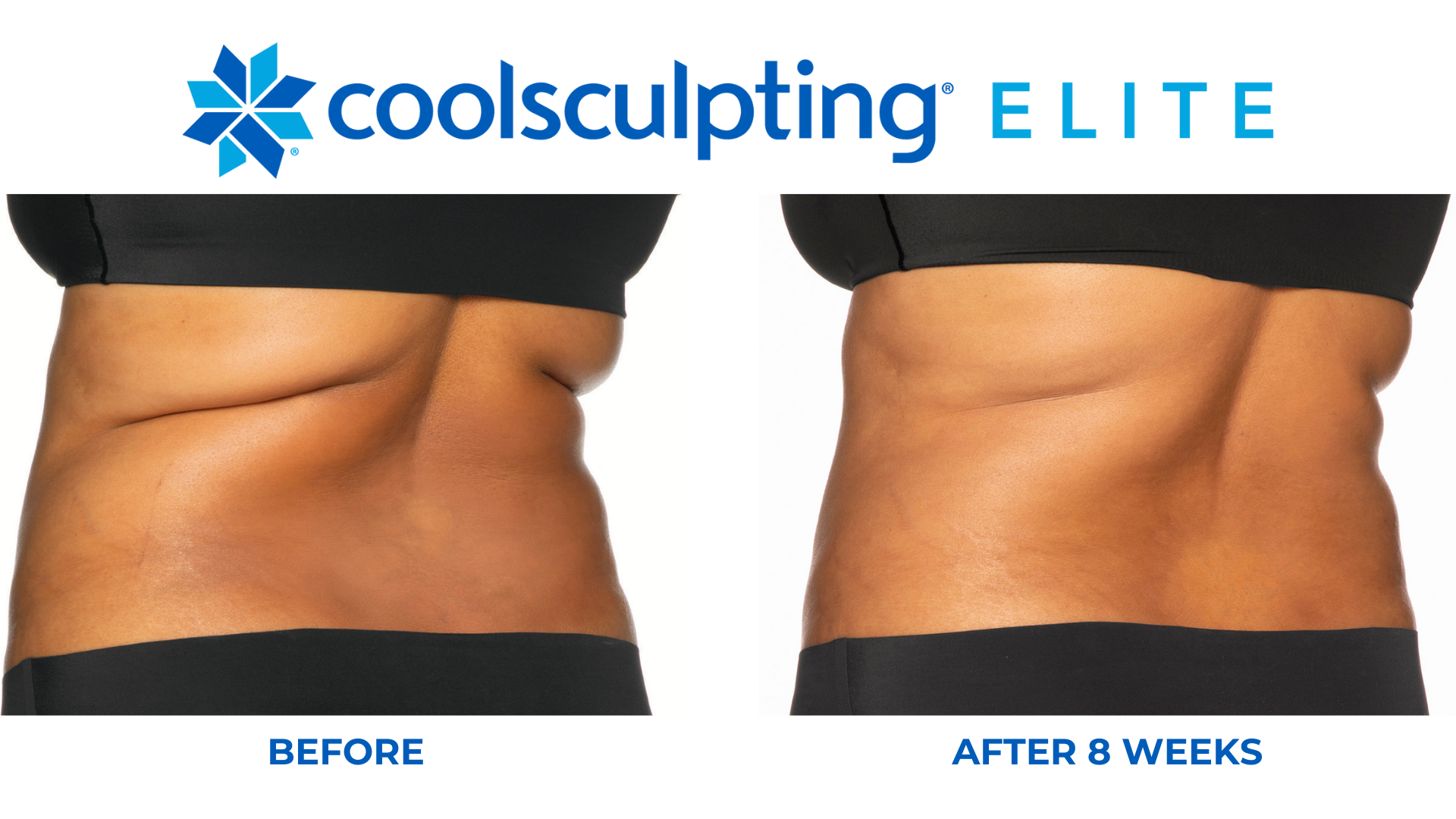 coolsculpting before and after