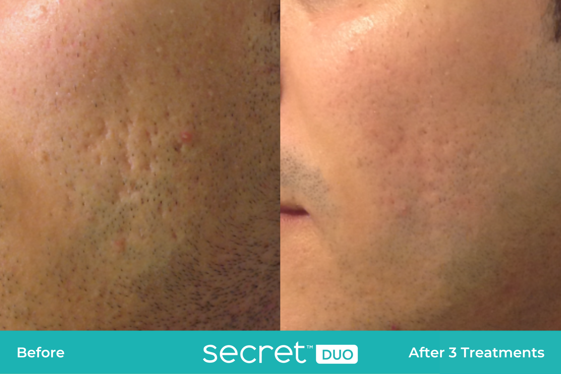 secret duo acne scars before and after