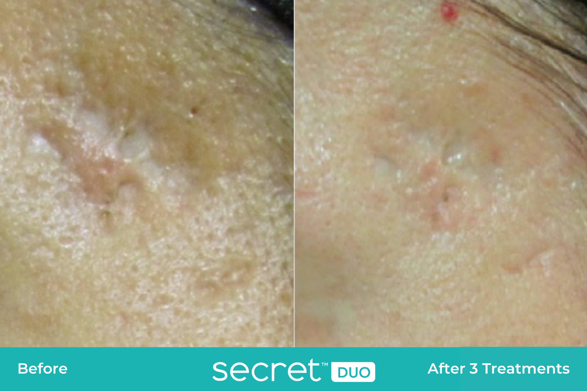 Secret Duo scar treatment before and after.