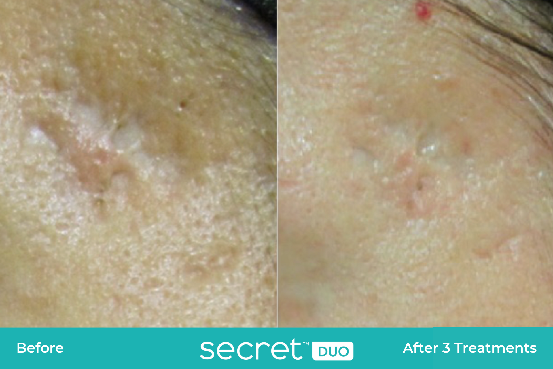 secret duo scar before and after