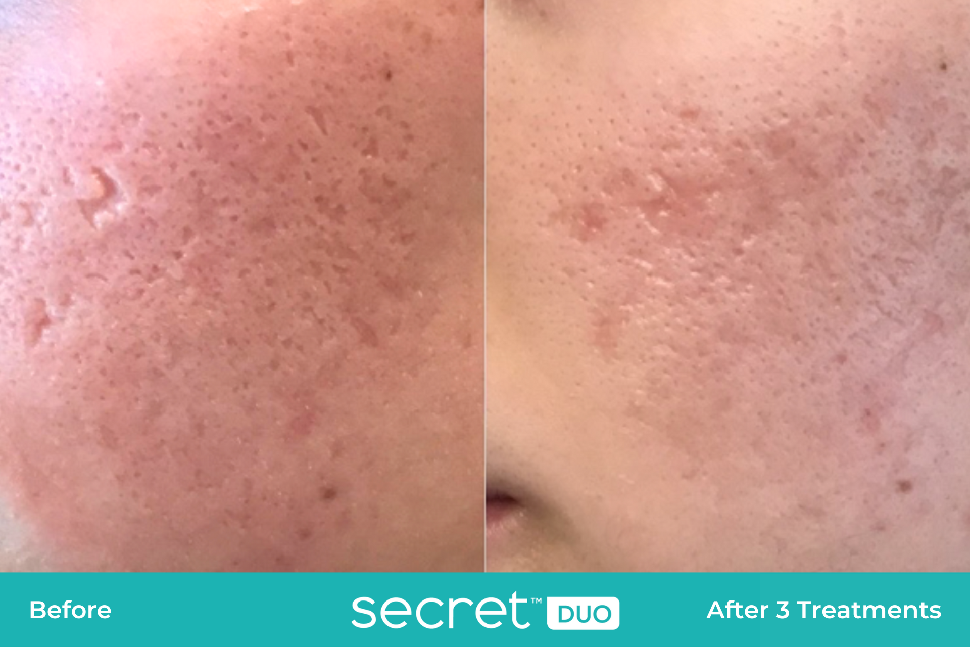 secret duo scars before and after