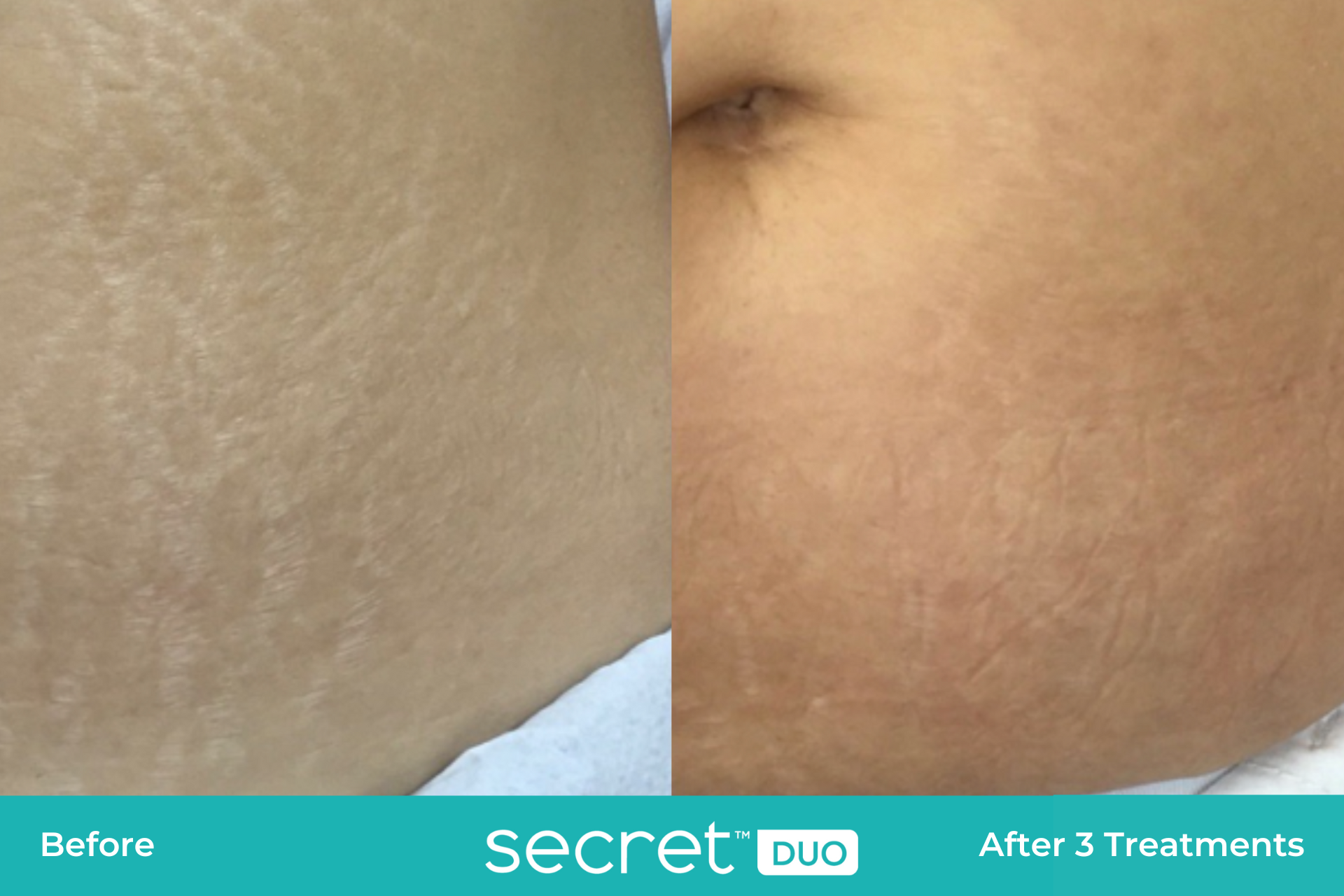 secret duo stretchmarks before and after