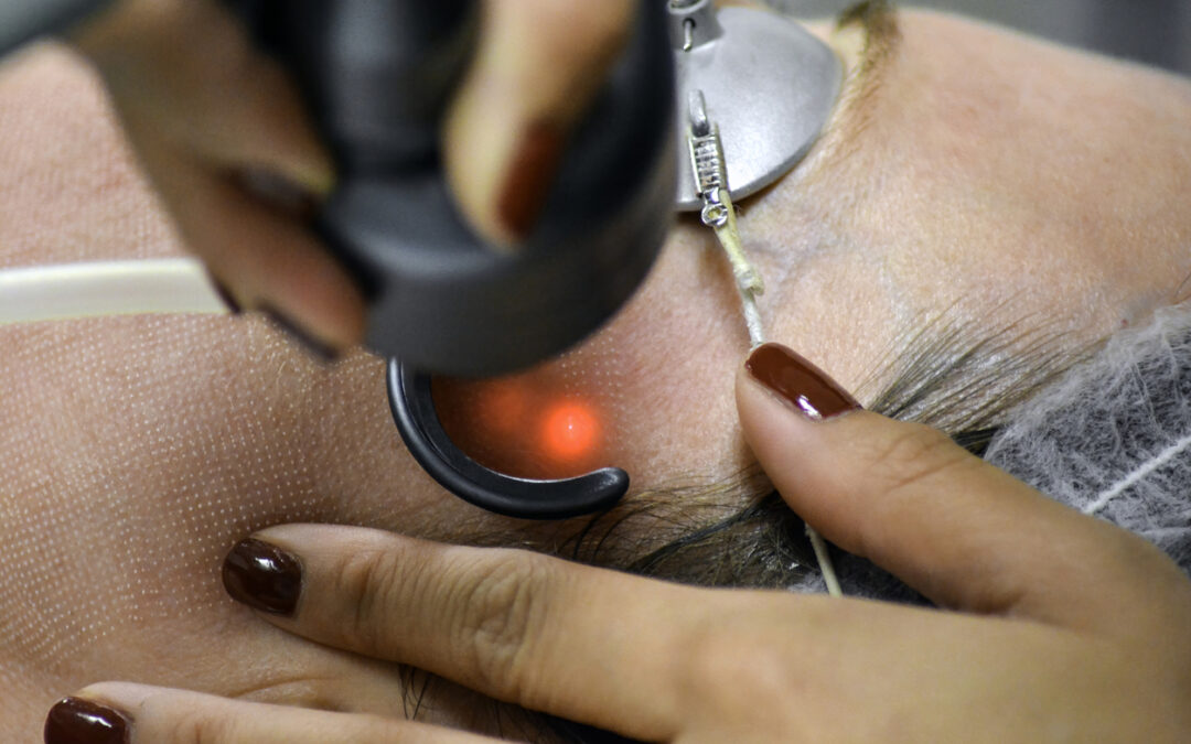 A skin resurfacing laser treatment is performed on a first-time laser treatment patient.